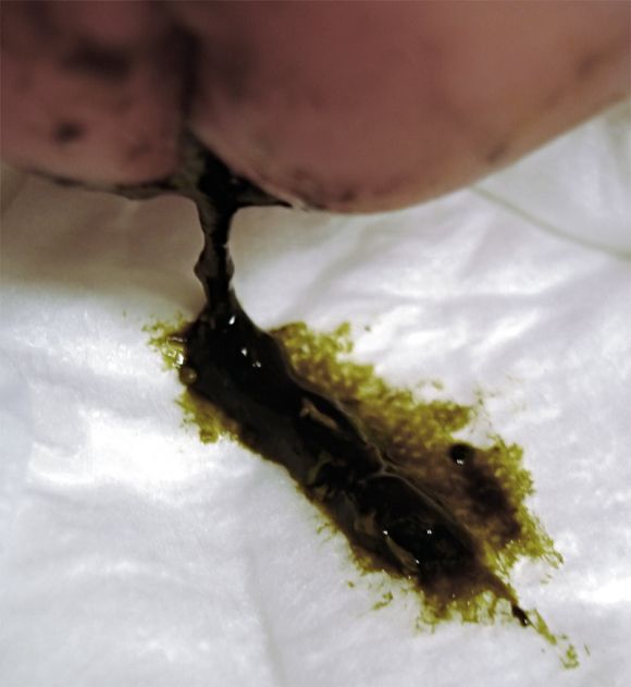 Escape of meconium in a newborn after 12 hours.