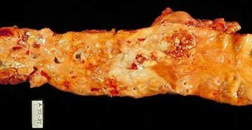 Aorta mit Arteriosklerose,