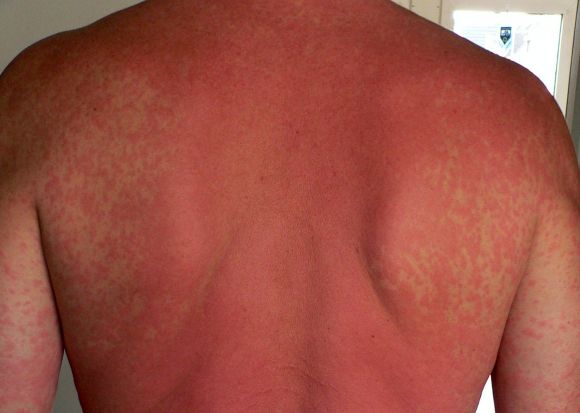 Allergic rash on the back of a man. Section: upper part of the back. Allergic rash on the back of a man. Section: upper part of the back.