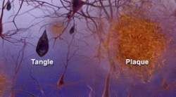 Progression of Alzheimer's disease. Neuronal death and the formation of neurofibrillary tangles etc. Progression of Alzheimer's disease. Neuronal death and the formation of neurofibrillary tangles etc.