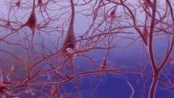 Onset of Alzheimer's disease. Leads to the death of neurons. See next picture. Onset of Alzheimer's disease. Leads to the death of neurons. See next picture.