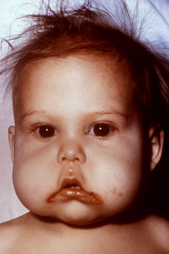 Bloated face of a toddler as a result of the illness Kwashiorkor. Photo 1970.