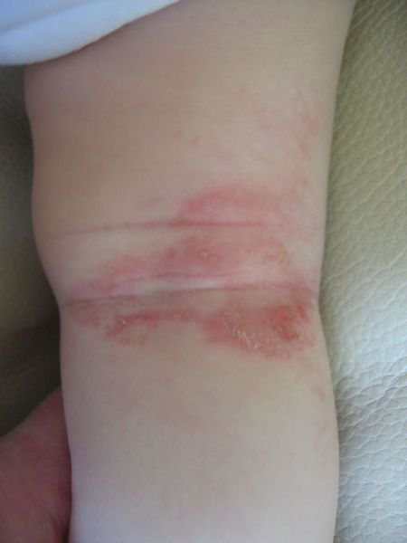 Eczema popliteo attraverso il latte vaccino in un bambino di 7 mesi. Eczema popliteo attraverso il latte vaccino in un bambino di 7 mesi.