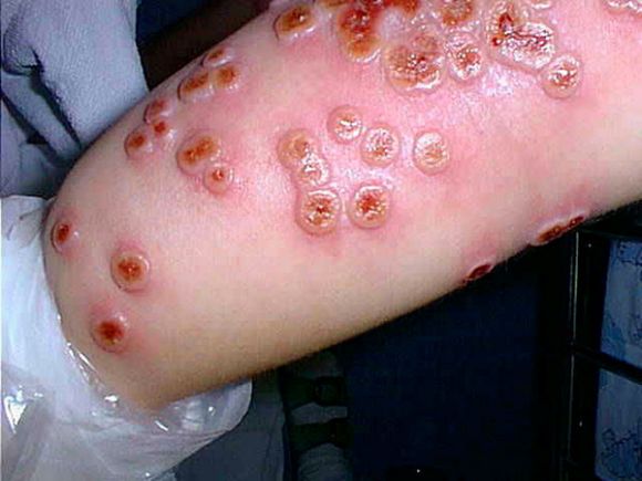 Cowpox on the arm of a 4-year-old girl in 2002.