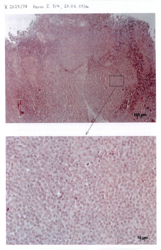 2013 Bestätigung Pathologisches Institut Luzern, histologische Schnittpräparate zeigen NHL.Bild,2/2