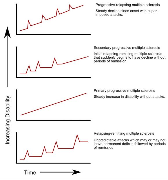 The various progressive forms of Multiple Sclerosis (MS)