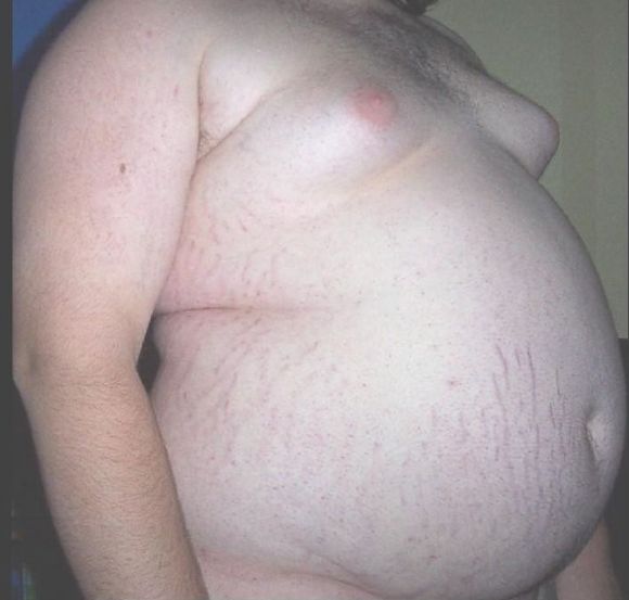 Ein junger fettsüchtiger Mann Mitte 20 mit BMI 52, Gewicht 182 kg, Grösse 177 cm.