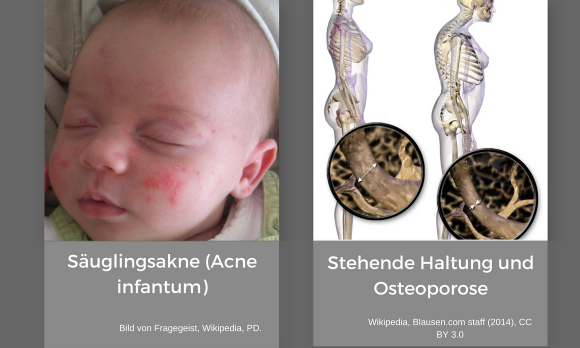 Gesicht eines Säuglings mit Säuglingsakne, rechts stehende Haltung normal und mit Osteoporose. Gesicht eines Säuglings mit Säuglingsakne, rechts stehende Haltung normal und mit Osteoporose.